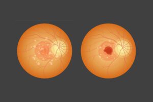 Read more about the article Age-related Macular Degeneration