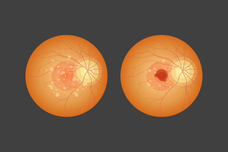 Read more about the article Age-related Macular Degeneration