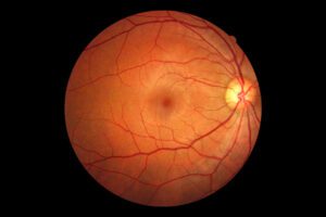 Read more about the article Retinal