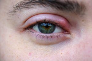 Read more about the article Chalazion