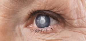 Read more about the article Επέμβαση καταρράκτη και αντιμετώπιση διαθλαστικών παθήσεων με ενδοφακούς